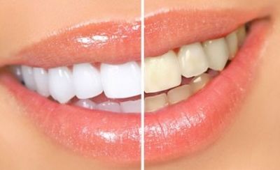 Быстрое отбеливание зубов в домашних условиях