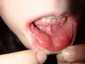 Что-то белое во рту? как лечить молочницу во рту у ребенка.
