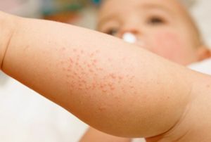 Сыпь у ребенка - на лице, животе, спине, лице, руках или ногах - что означает. какие бывают виды сыпи у детей и как лечить.